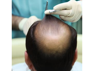 Hair Transplant For 1 Dirham in Dubai