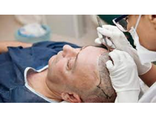 Top Myths and Facts about Hair Transplant Surgery
