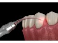 best-teeth-caries-treatment-in-btm-layout-perfect-dental-studio-small-0