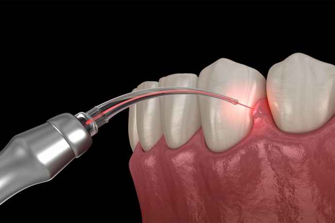 best-teeth-caries-treatment-in-btm-layout-perfect-dental-studio-big-0
