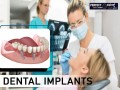 best-dental-implants-in-btm-layout-bangalore-perfect-dental-studio-small-0