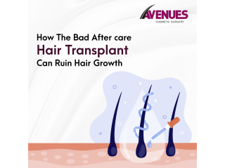 Best Hair Loss Treatment in Ahmedabad, Avenues Cosmetic.